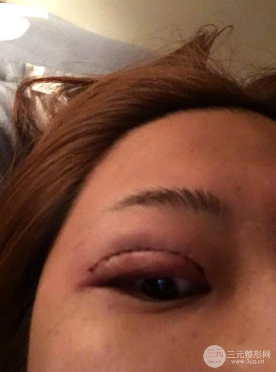 無錫菲尚徐火旺雙眼皮案例