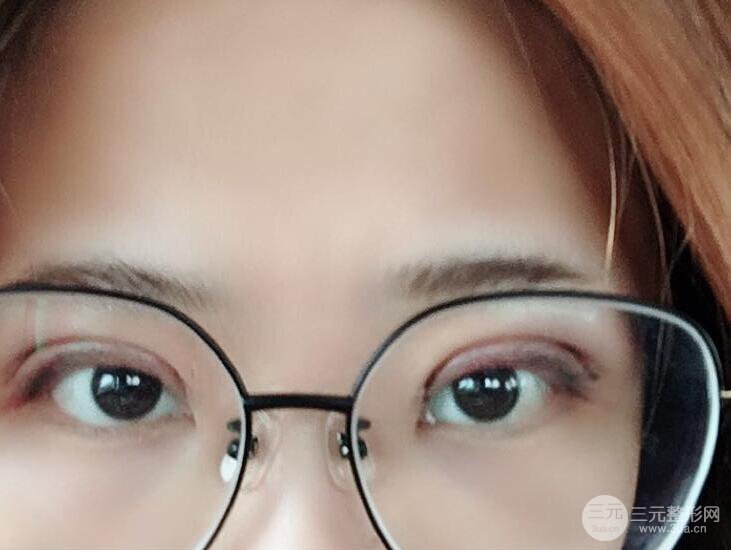 無錫菲尚徐火旺雙眼皮案例