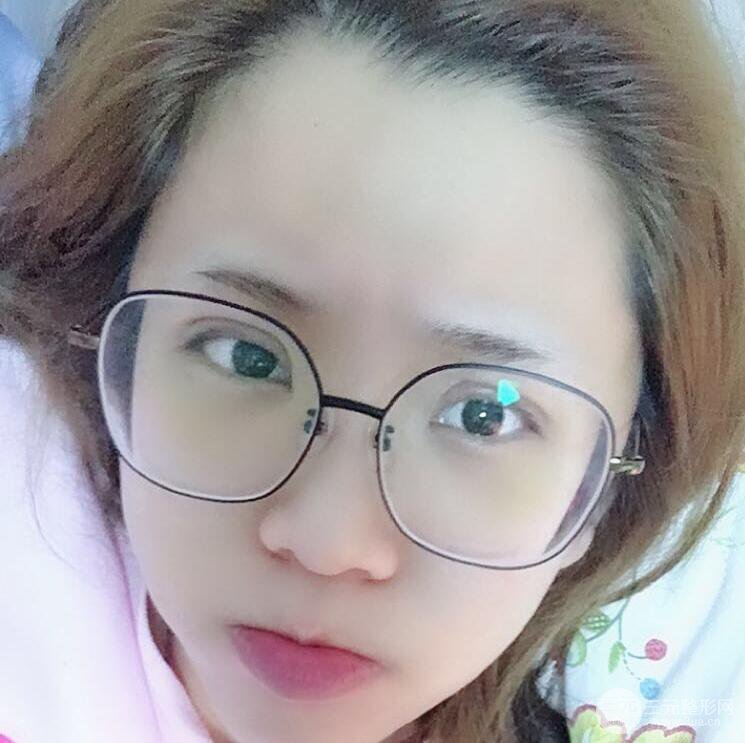 無錫菲尚徐火旺雙眼皮案例