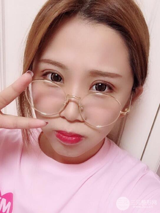 無錫菲尚徐火旺雙眼皮案例