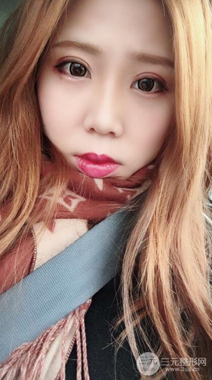 無錫菲尚徐火旺雙眼皮案例