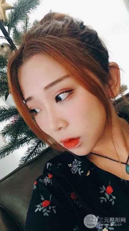 無錫菲尚徐火旺雙眼皮案例