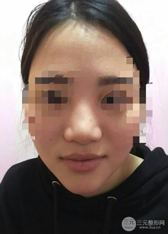 長(zhǎng)沙亞韓整形醫(yī)院鄭京湘假體隆鼻