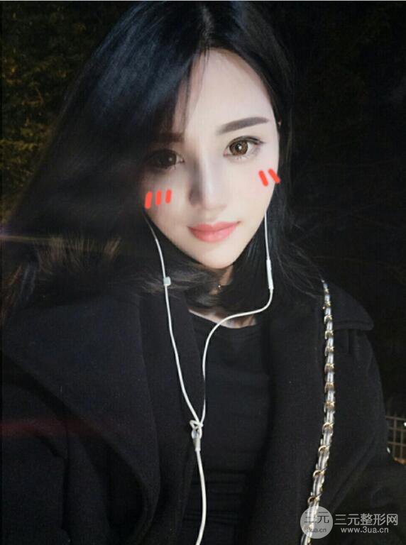 長(zhǎng)沙亞韓整形醫(yī)院鄭京湘假體隆鼻