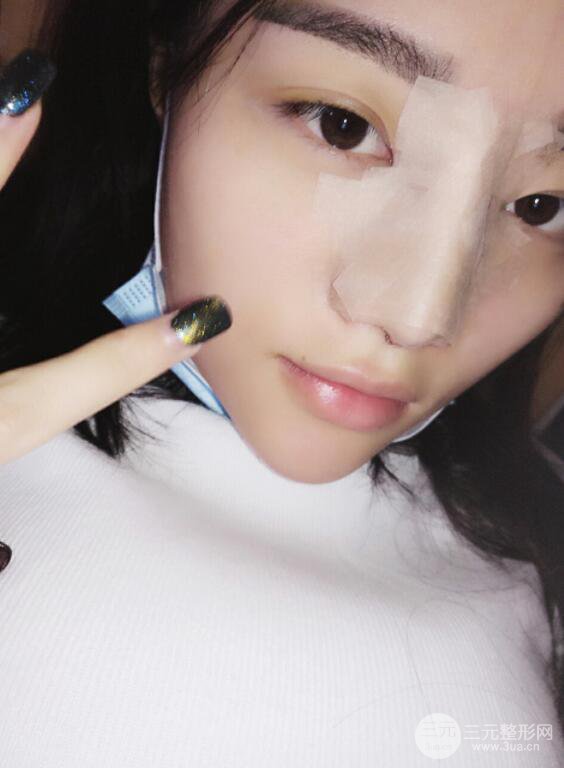 長(zhǎng)沙亞韓整形醫(yī)院鄭京湘假體隆鼻