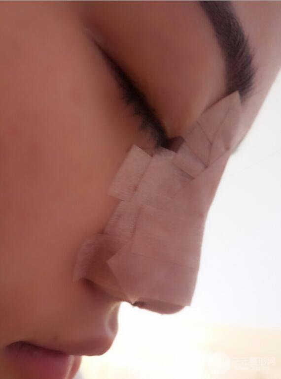 長(zhǎng)沙亞韓整形醫(yī)院鄭京湘假體隆鼻