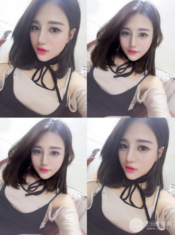 長(zhǎng)沙亞韓整形醫(yī)院鄭京湘假體隆鼻