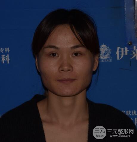 磨骨瘦臉（下頜角切除）恢復(fù)過(guò)程及前后對(duì)比照片