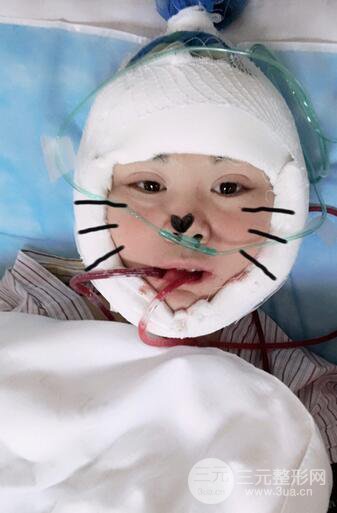 磨骨瘦臉（下頜角切除）恢復(fù)過(guò)程及前后對(duì)比照片