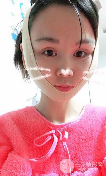 磨骨瘦臉（下頜角切除）恢復(fù)過(guò)程及前后對(duì)比照片