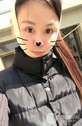 磨骨瘦臉（下頜角切除）恢復(fù)過(guò)程及前后對(duì)比照片