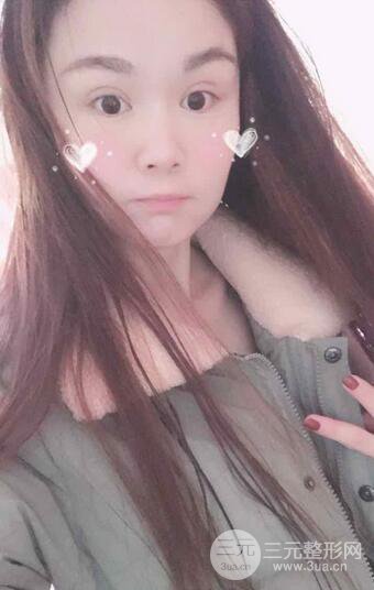 磨骨瘦臉（下頜角切除）恢復(fù)過(guò)程及前后對(duì)比照片