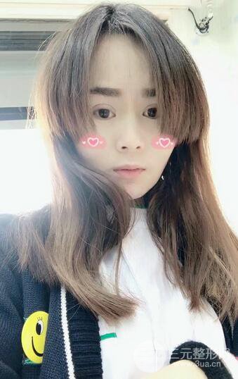 磨骨瘦臉（下頜角切除）恢復(fù)過(guò)程及前后對(duì)比照片