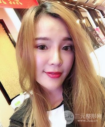 模特做隆鼻整形真實日記分享,附上恢復(fù)過程圖