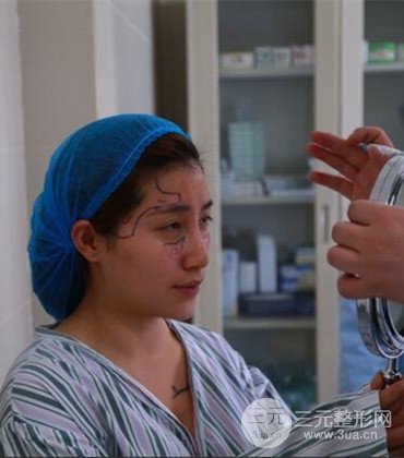 網(wǎng)絡(luò)主播做自體脂肪豐太陽(yáng)穴真實(shí)案例分享,果杠杠的