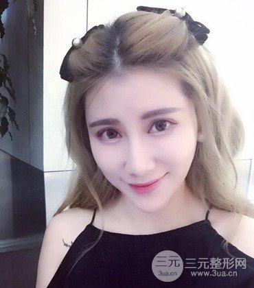 網(wǎng)絡(luò)主播做自體脂肪豐太陽(yáng)穴真實(shí)案例分享,果杠杠的