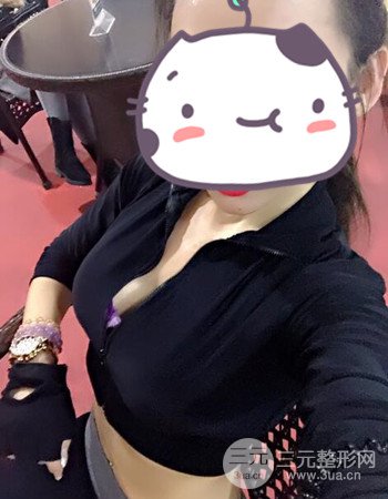蘇州假體隆胸手術(shù)案例分享、前后對比圖分享