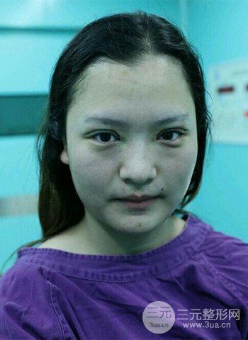 深圳雙眼皮正就內(nèi)雙小眼睛,真實(shí)案例前后對比照片