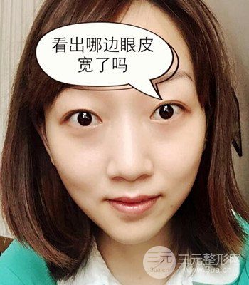 北京雙眼皮失敗修復(fù)手術(shù)日記分享，附上前后對(duì)比照片