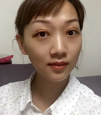 北京雙眼皮失敗修復(fù)手術(shù)日記分享，附上前后對(duì)比照片