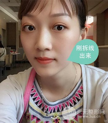 北京雙眼皮失敗修復(fù)手術(shù)日記分享，附上前后對(duì)比照片