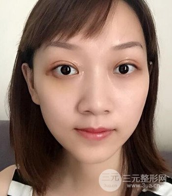 北京雙眼皮失敗修復(fù)手術(shù)日記分享，附上前后對(duì)比照片