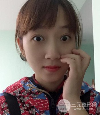北京雙眼皮失敗修復(fù)手術(shù)日記分享，附上前后對(duì)比照片