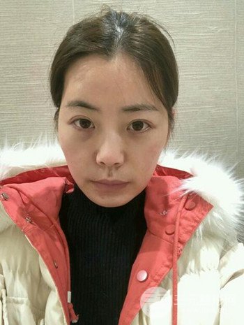 主播在深圳美臣做了自體脂肪全臉填充手術(shù)日記分享