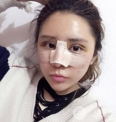 隆鼻整形+埋埋蛋白線.提升+自體脂肪全臉填充術(shù)后改頭換面！