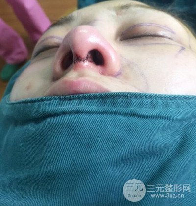 隆鼻整形+埋埋蛋白線.提升+自體脂肪全臉填充術(shù)后改頭換面！