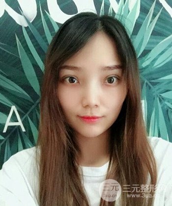 雙眼皮失敗修復手術日記分享,改變雙眼皮不對稱