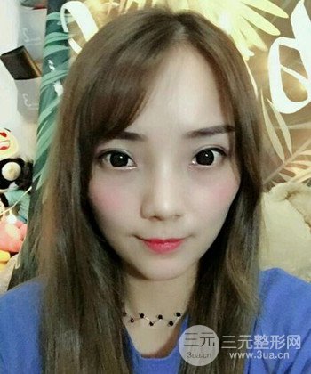 雙眼皮失敗修復手術日記分享,改變雙眼皮不對稱
