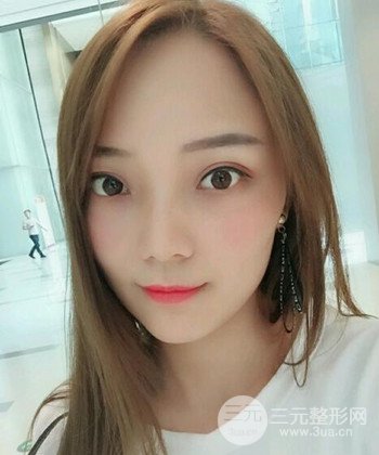 雙眼皮失敗修復手術日記分享,改變雙眼皮不對稱