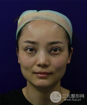 雙眼皮失敗修復手術日記分享,改變雙眼皮不對稱