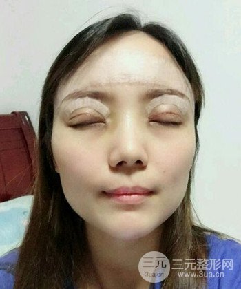 雙眼皮失敗修復手術日記分享,改變雙眼皮不對稱