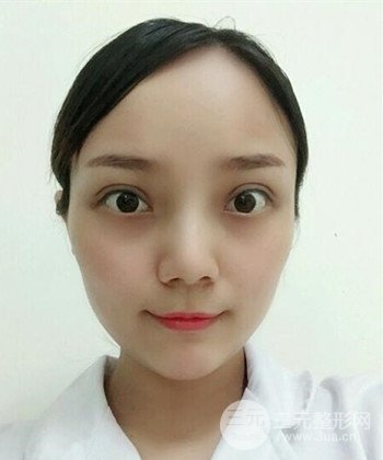 雙眼皮失敗修復手術日記分享,改變雙眼皮不對稱