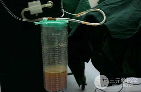 梨型身材做了大腿吸脂之后果超明X，吸脂恢復(fù)過程分享