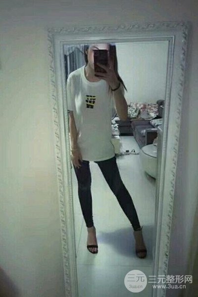 梨型身材做了大腿吸脂之后果超明X，吸脂恢復(fù)過程分享