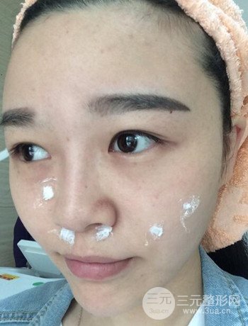 北京激光去雀斑真實(shí)案例分享,純素顏無濾鏡果圖