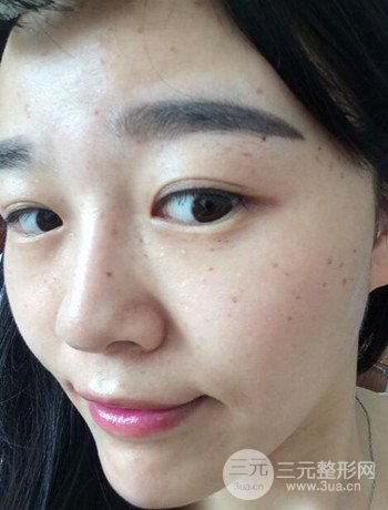 北京激光去雀斑真實(shí)案例分享,純素顏無濾鏡果圖