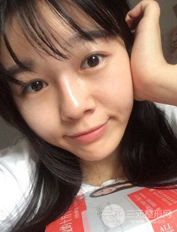 北京激光去雀斑真實(shí)案例分享,純素顏無濾鏡果圖