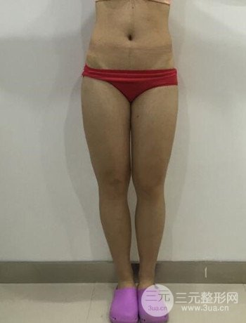吸脂瘦大腿手術(shù)經(jīng)歷分享,纖細(xì)雙腿不再是夢