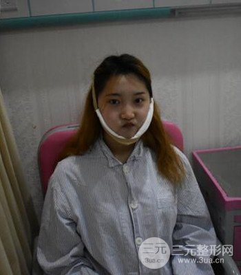 終于做了下頜角整形,分享術(shù)后恢復(fù)果