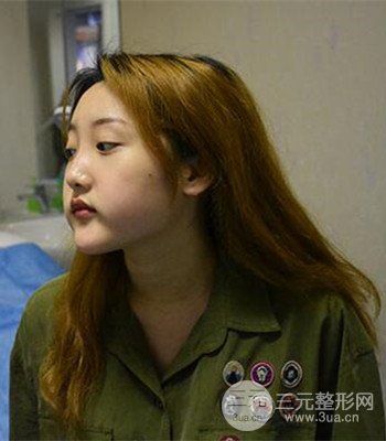 終于做了下頜角整形,分享術(shù)后恢復(fù)果