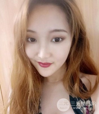 終于做了下頜角整形,分享術(shù)后恢復(fù)果