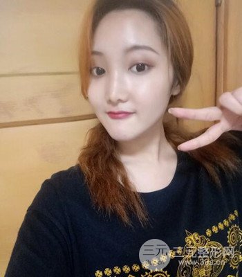 終于做了下頜角整形,分享術(shù)后恢復(fù)果