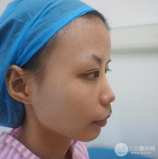 銀川崔大夫博士麗朱杰硅膠隆鼻恢復(fù)圖,輕松get精致臉