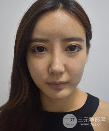 全臉自體脂肪填充手術(shù)日記分享，改良臉型年輕十歲