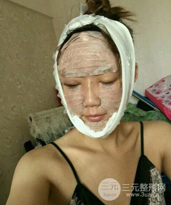 全臉自體脂肪填充手術(shù)日記分享，改良臉型年輕十歲