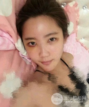 全臉自體脂肪填充手術(shù)日記分享，改良臉型年輕十歲